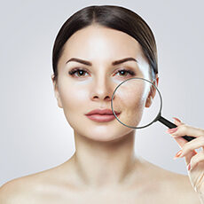Acne and Acne Scars