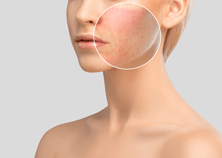 Pigmentation