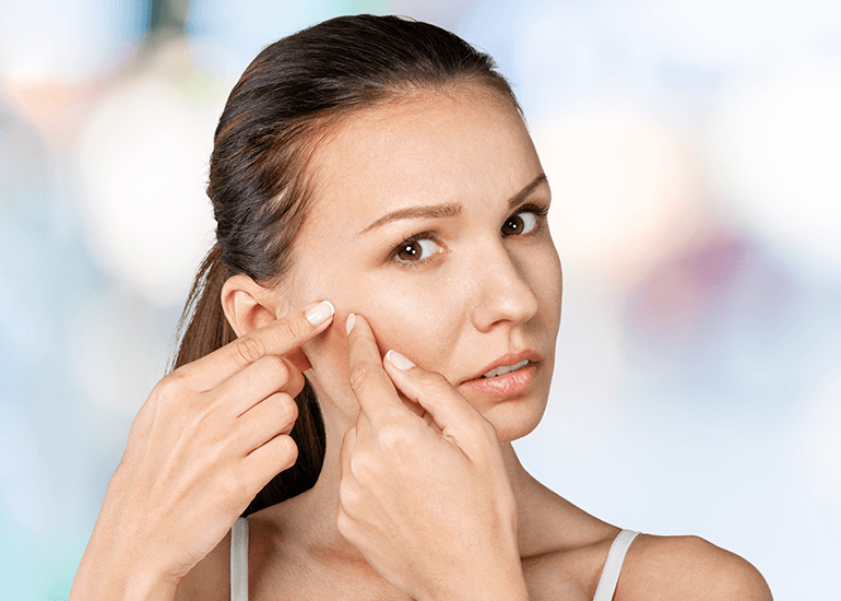 Acne and Acne Scars